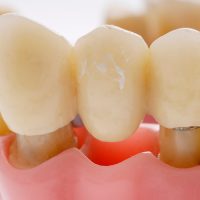 DENTURE MAKING